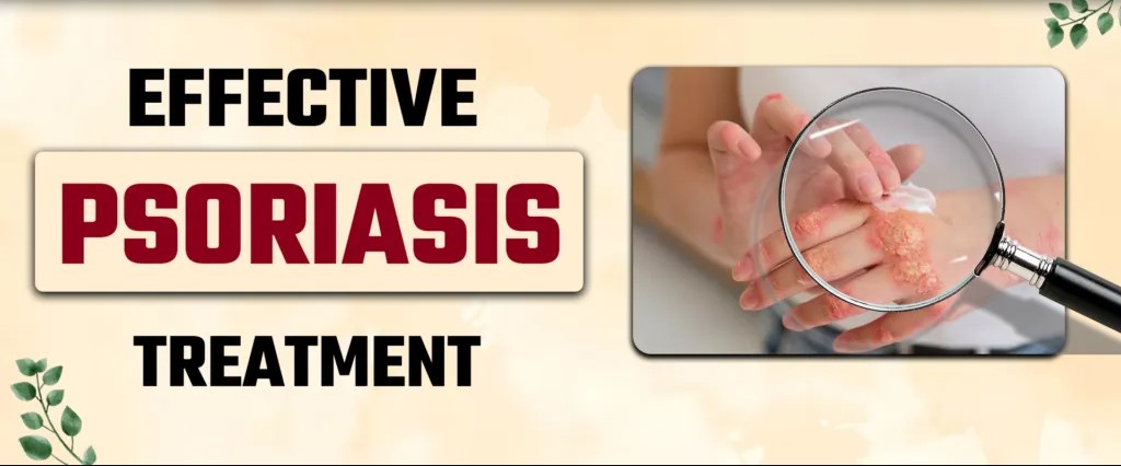 homeopathy treatment for psoriasis